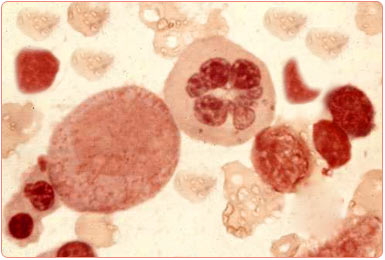 Anemia - keadaan perubatan di mana kiraan sel darah merah atau hemoglobin adalah kurang daripada biasa.  