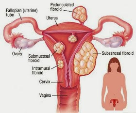 Fibroid ketika hamil,Pengedar Shaklee kepala batas,shaklee bertam,shaklee sungai petani,shaklee bukit mertajam,shaklee butterworth,shaklee penang,shaklee kedah,shaklee utara,shaklee perak,shaklee nibong tebal,shaklee seberang perai,shaklee bertam,shaklee bertam putra ,shaklee bertam perdana,Shaklee prai,Shaklee penaga,Shaklee Bandar perda,shaklee indonesia ,shaklee taiwan,shaklee sabah,shaklee malaysia,shaklee penaga,Fibroid ketika hamil,shaklee untuk fibroid ketika hamil ,bahaya fibroid ketika hamil  