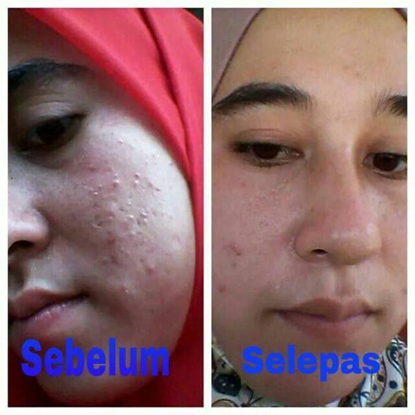 Testimoni Set Penjagaan Kulit Enfuselle ,Bahaya kosmetik murahan,Shaklee kepala batas, shaklee bertam,shaklee bertam perdana, shaklee bertam putra , shaklee pulau pinang, shaklee penaga,shaklee sungai petani, shaklee seberang jaya, shaklee butterwoth, shaklee bukit mertajam, shaklee kedah, shaklee malaysia, 