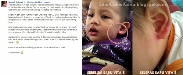 Testimoni Shaklee: Rawatan Eczema 