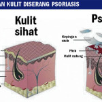 Shaklee Penang:Testimoni Penyakit Kulit Psoriasis