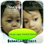 Shaklee Kepala Batas:Testimoni Herbal Blend Untuk Chicken Pox