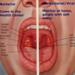 Pengedar Aktif  Shaklee Kepala Batas:Vitamin Untuk Bengkak Tonsil