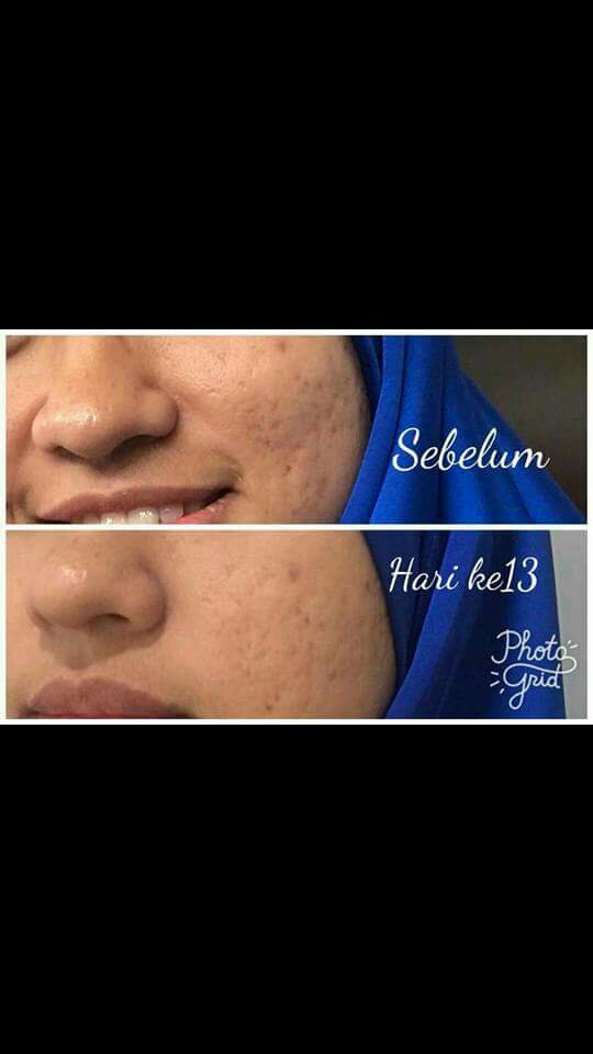 Testimoni Youth SkinCare Shaklee