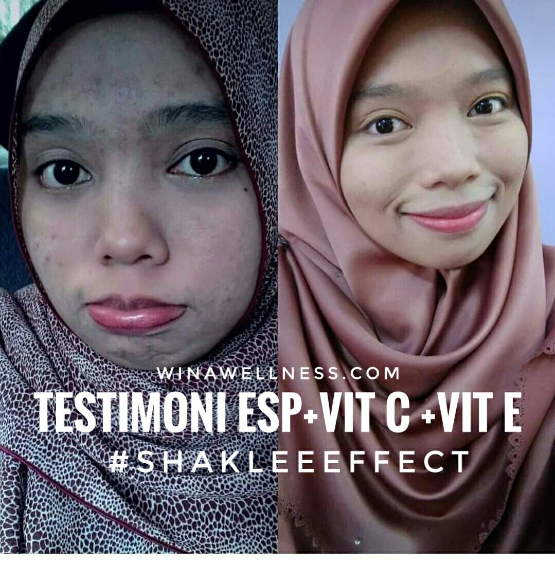 Pengedar Aktif Shaklee Kepala Batas :Testimoni set Kecantikan Kulit Shaklee 