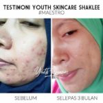Testimoni Youth Skin Care Jerawat Hilang