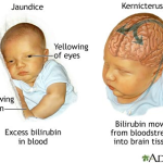 Apa punca bayi jaundice