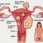 Fibroid ketika hamil