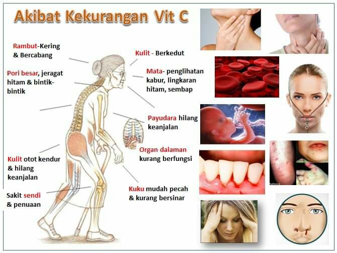 Tanda-Tanda Kekurangan Vitamin C-Pengedar Shaklee Penang